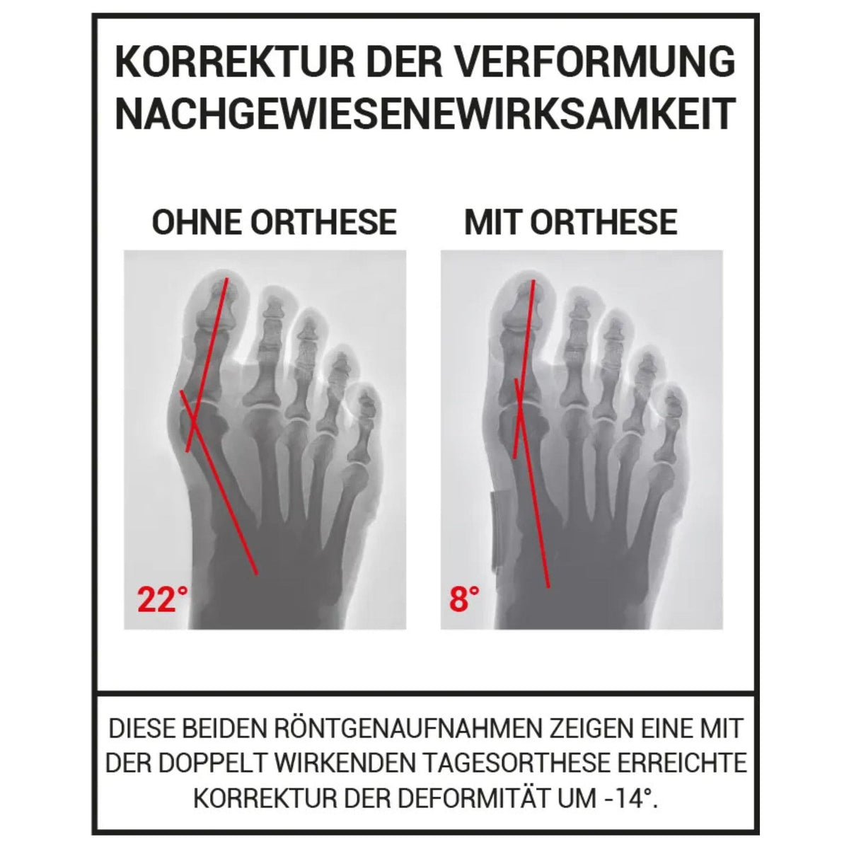 Hallux Valgus Erklärung