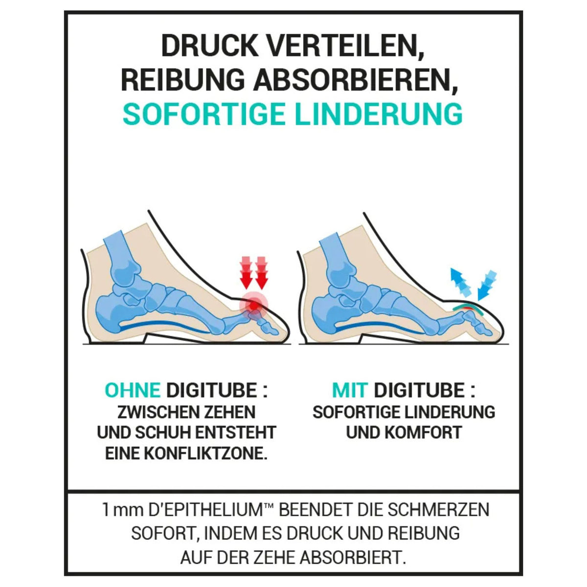 Hühneraugen am Zeh Gelschlauch