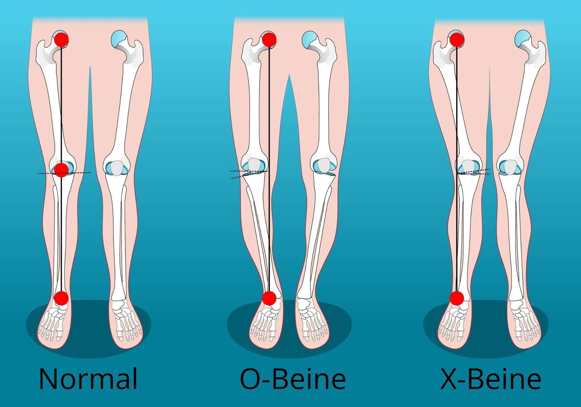 X-Beine Darstellung
