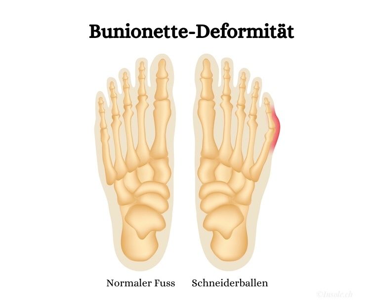 Bunionette-Deformität Schneiderballen
