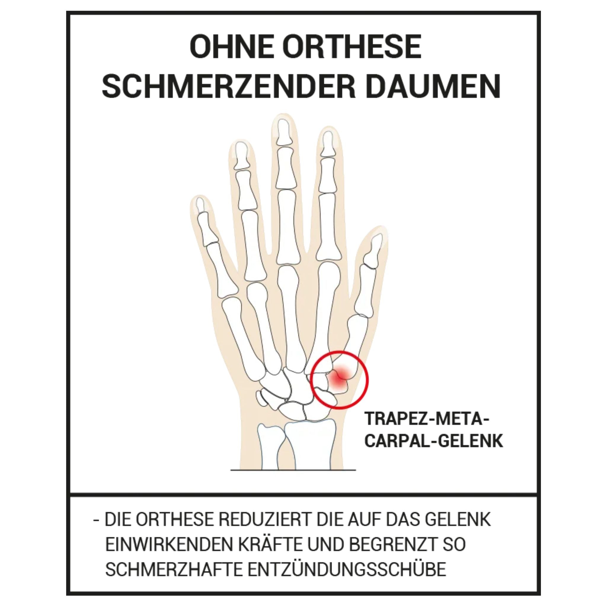 Erklärung Rhizarthrose Daumen