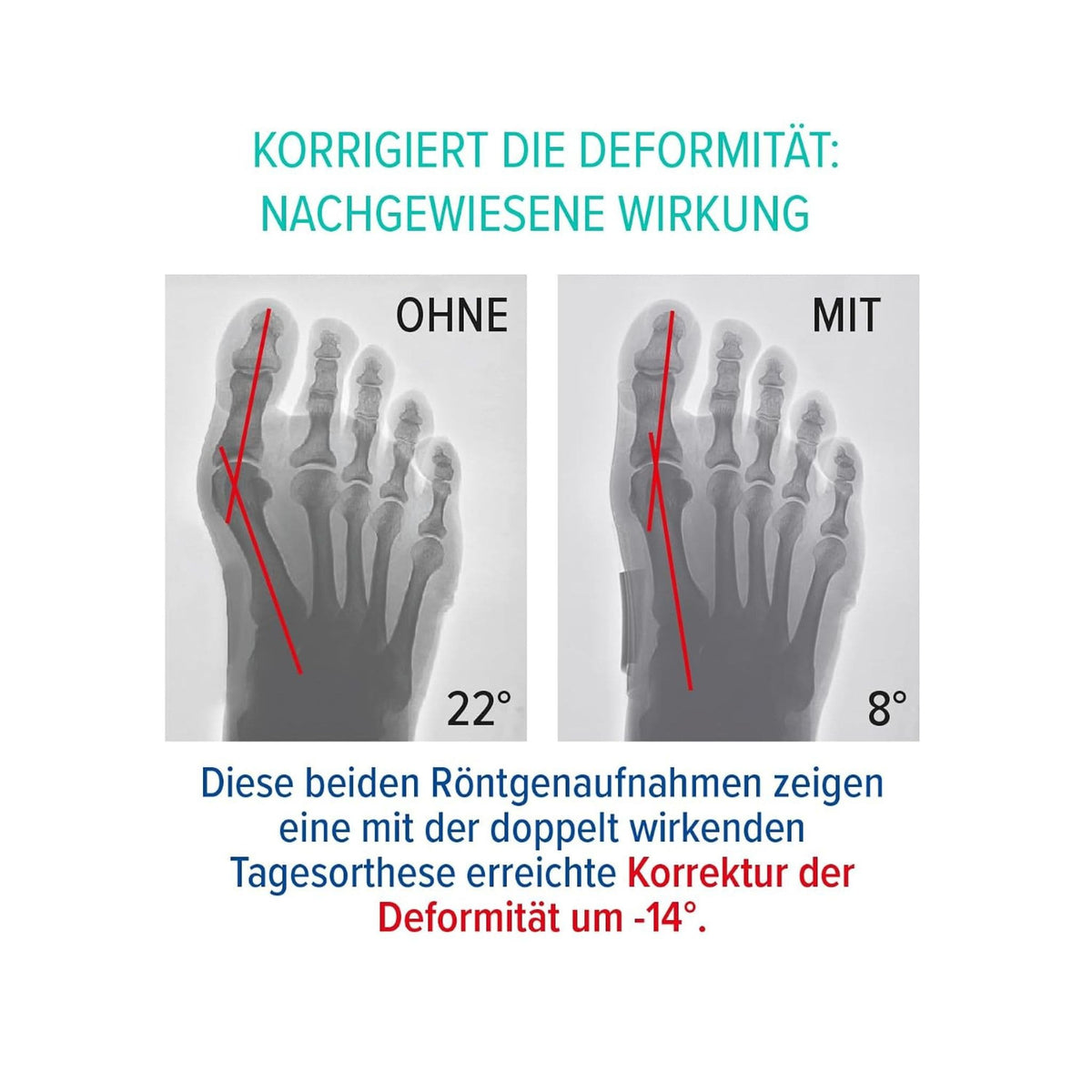 Hallux Valgus Tagesbandage Erklärung